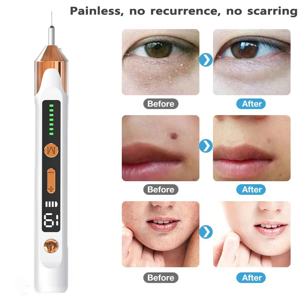 Freckle Removal Plasma Pen for Skin Care