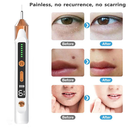 Freckle Removal Plasma Pen for Skin Care