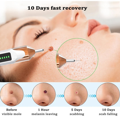 Dark Spot Removal Laser Plasma Machine